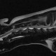 首の椎間板ヘルニア　MRI画像